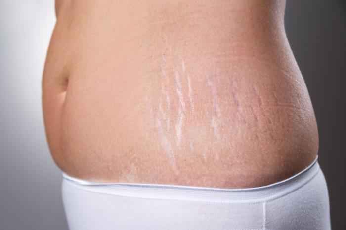 Stretch marks