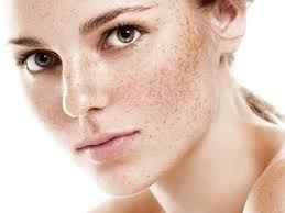 Melasma/ Hyper Pigmentation